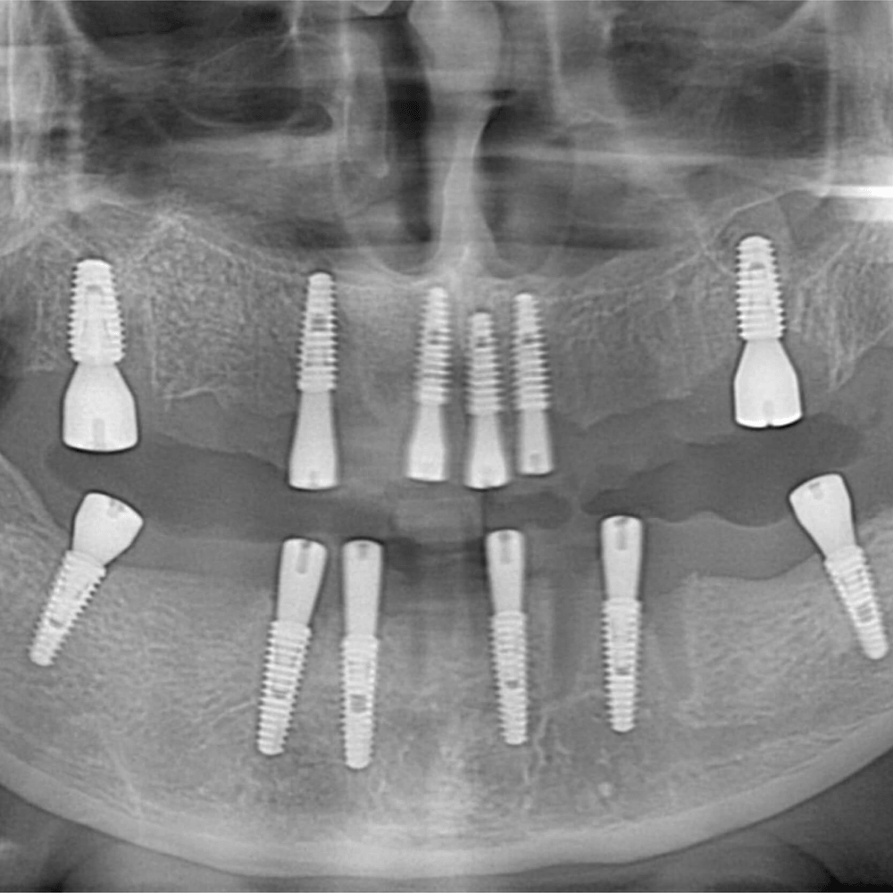 All On Six İmplant