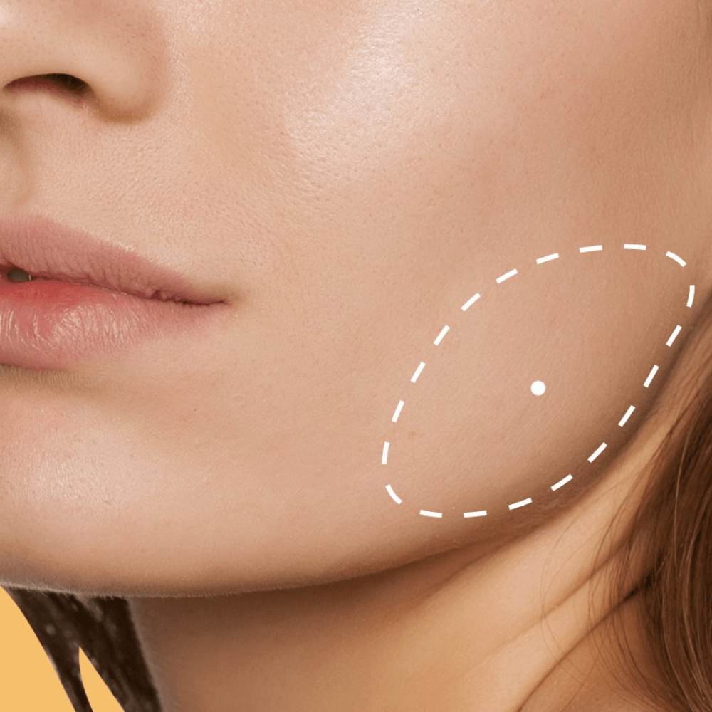 Masseter Botoks