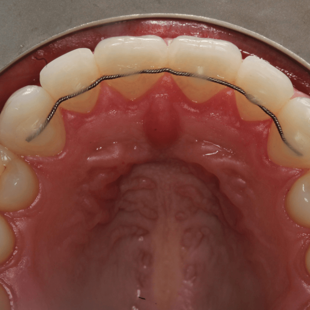 retainer